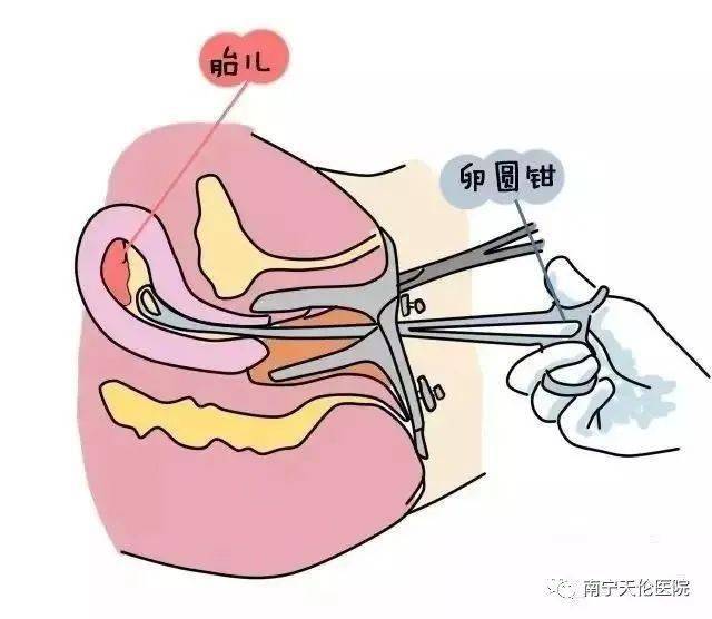 关于四个月流产的详细过程与注意事项