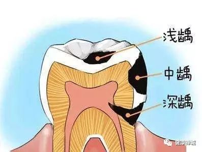 蛀牙等一个月，牙齿健康的重要性与应对策略