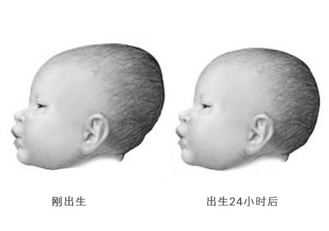 九个月宝宝的囟门正常值解析